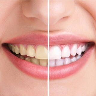 آشنایی با مواد غذایی طبیعی برای سفید کردن دندان‌ها